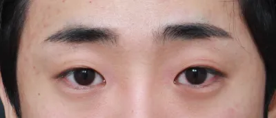 因為眼睛看起來很無神，加上睫毛一直倒插，所以下定決心要做了。