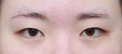 這次原本是單眼皮的我做了眼睛整形（初眼）..