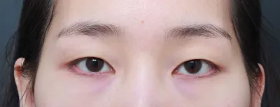 之前一直猶豫要不要做手術，現在覺得做了真是太好了！