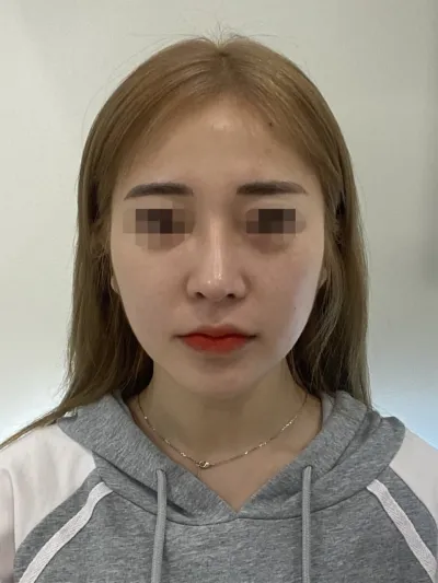 覺得臉部不夠飽滿，所以做了全臉脂肪填充！