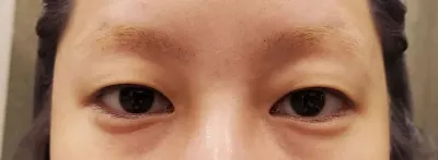 做完自然黏合已經一個多月了～