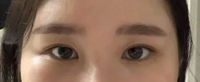 做完雙向開眼角後非常滿意。