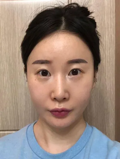 在 Very Good 做二次手術已經 3 個月了！