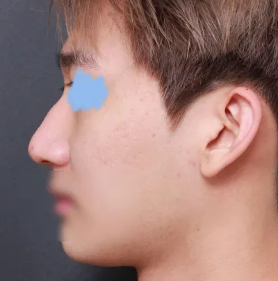 在 Very Good 整形外科進行隆鼻手術滿一個月的心得！