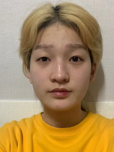 手術後4個月，不用化妝了！！