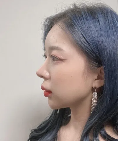 在Very Good進行鷹鉤鼻矯正第9個月的後記！