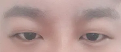 做了非切開提肌手術。