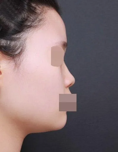 隆鼻手術一個月後的心得分享