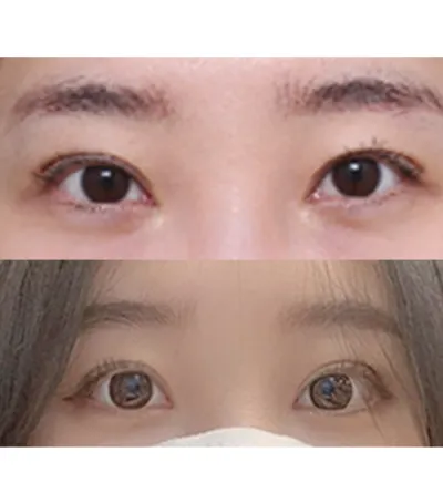 手術完一個多月了。