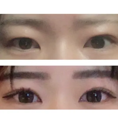 做了雙眼皮手術，現在非常滿意，因為太開心了所以發個文。