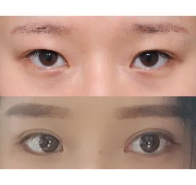 我以前做過切開式雙眼皮，但後來雙眼皮摺痕變得越來越內陷，一直讓我感到很有壓力，所以選擇了進行重修手術。