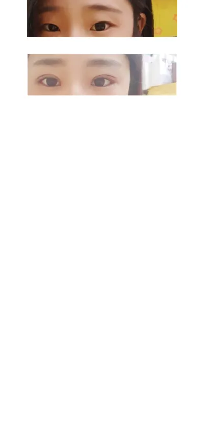 我做了雙眼皮、自然黏連、開眼頭、開眼尾~~^^