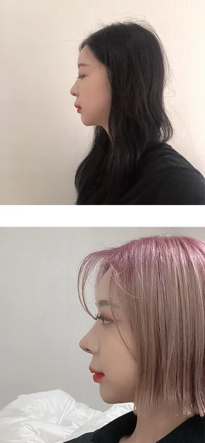 隆鼻手術6個月後的心得。