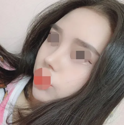 做了初次隆鼻、鼻樑、鼻尖、短鼻、縮鼻翼。