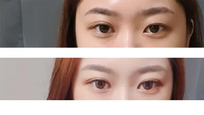 在 Very Good 做完第一次雙眼皮手術已經過了大約 3 個月，來分享一下心得～