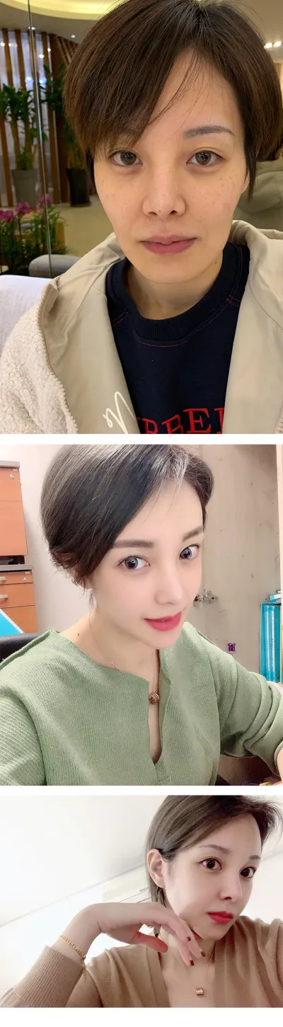 好像已經快一年了，臉部凹凸不平的情況改善了很多哈哈，臉部輪廓變好之後，自拍也拍得很漂亮哈哈哈。