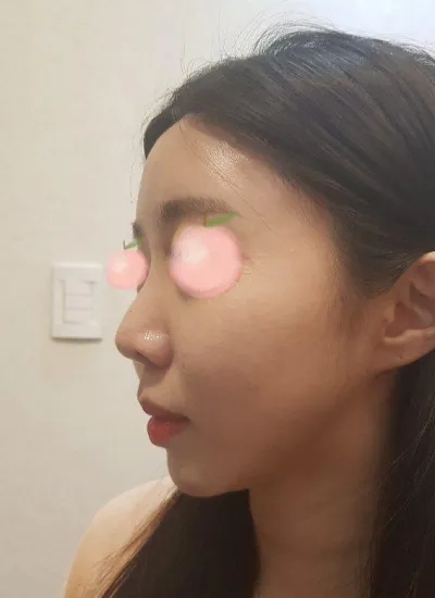 我做了自體肋軟骨隆鼻，目前非常滿意哈哈哈哈