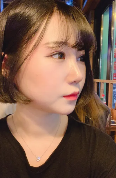 初次眼部手術、眼型矯正、開前眼角、雙向開眼角、鼻樑、鼻尖、駝峰鼻矯正，非常滿意。