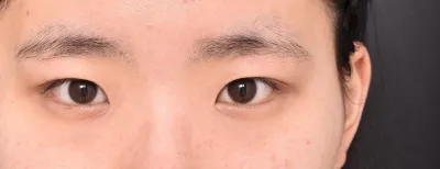 做完雙眼皮不知不覺已經 4 個月了 'ㅜ'!!!