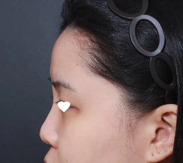 在 Very Good 整形外科找林榮敏院長做了鼻子手術喔呵呵