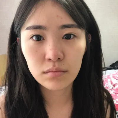 做完鼻子手術快4個月了！