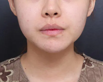 臉部抽脂後大約一個月了，臉部輪廓變得很明顯，非常滿意！