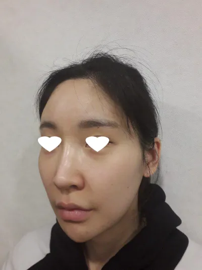 顴骨縮小術非常自然，我很滿意^^