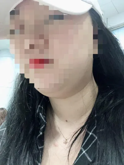 因為一直很困擾雙下巴的問題，所以做了臉部抽脂。