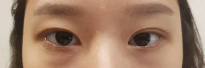 這是手術後快三個月的照片~~ 來分享心得囉!!~