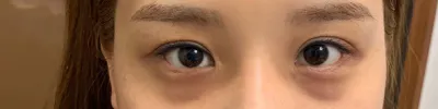 做了眼袋脂肪回填～分享心得～