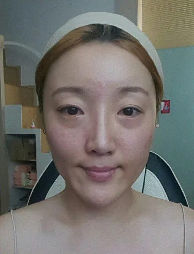 雙眼皮（切開）+ 後眼角下至 + 輪廓三項 + 眼底脂肪重新配置 第3週心得。