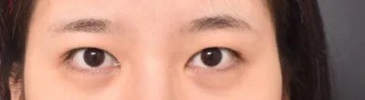 眼睛重修手術第4個月了，現在過得非常滿意。♥