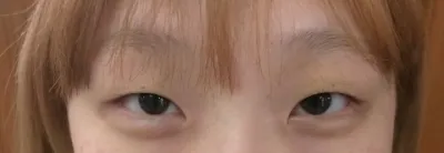 手術後大約過了3個月，腫脹漸漸消退，感覺正在定型中！！