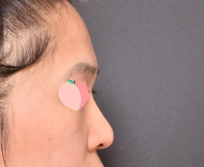 我在 Very Good 整形外科找林榮敏院長做了隆鼻手術喔。