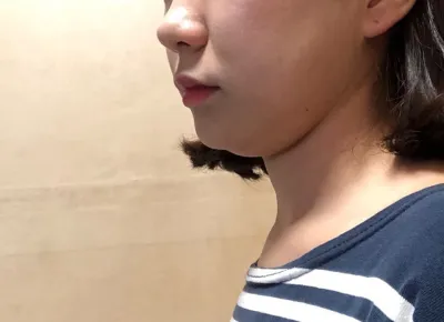 雙下巴抽脂簡直是新世界..bb