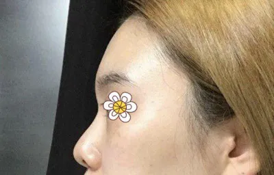 鼻修復太漂亮了!!!!