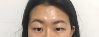 在 Very Good 整形外科找金俊賢院長做了額頭拉提和埋線提眼肌手術。