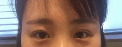 眼部整形後第12天的心得～