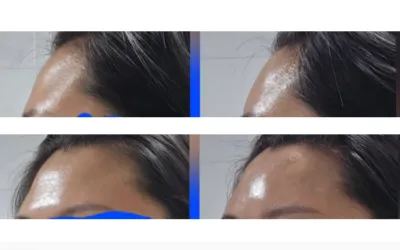 [車**顧客] 額頭填充劑手術後記