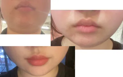 [**顧客] InMode+Beauty Fit注射手術後記