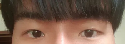 眼睛重修手術後記