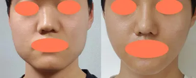 臉部輪廓手術後記