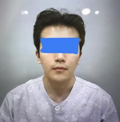 臉部輪廓手術後記