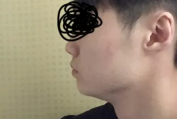 臉部輪廓 | 其他手術心得
