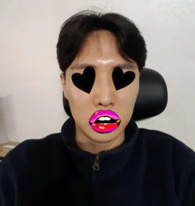 隆鼻重修 | 拉提手術心得