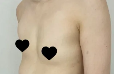 這是隆乳手術的心得。