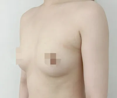 賽彬Sub第6個月) ☆從75B到65E☆ 改善不對稱☆