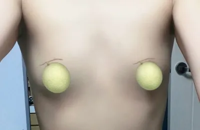 曼托 Xtra 2個月) 金周元院長真是神之手！！