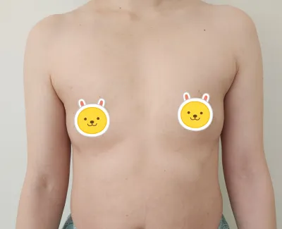 [二次手術] 蜜瓜胸術後1週！