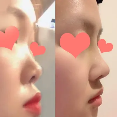 隆鼻手術後記!!